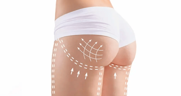 N&acirc;ng m&ocirc;ng bằng mỡ tự th&acirc;n giữ được bao l&acirc;u? [Giải đ&aacute;p 2024]